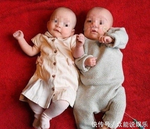 泰勒|奇闻：女子孕检是双胞胎，10个月后生下一个双色婴儿，嵌合体？
