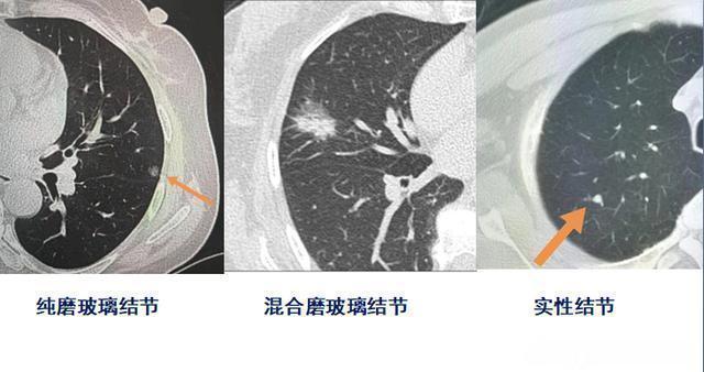 结节|两个肺癌病人都拖了2年才治疗，一个治愈，一个扩散了