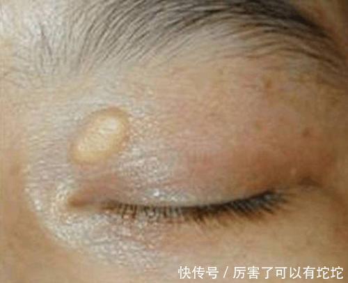 血脂升|心内科医生:血脂高不高看脸就知道,血脂高的人,脸上有3个特征