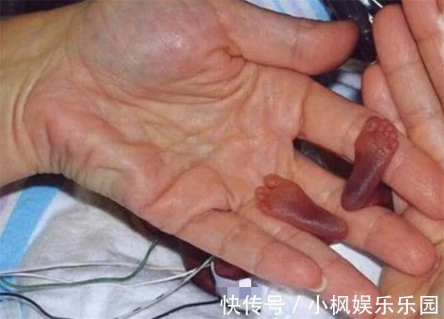 存活|世界上最小的婴儿，放在手心比巴掌还小，现在变成了这个样子