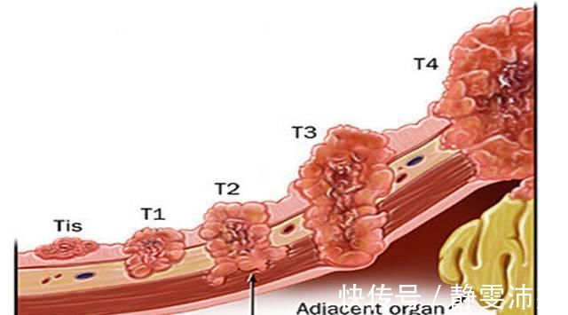 晚期|“胃癌从早期到晚期”大概需要经历多长时间