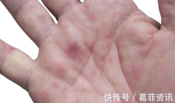 凝血功能|肝硬化到来时，身体会有5种情况，若你有，这3个行为要远离