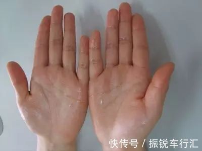 汗腺|汗从哪里出,病从哪里来!夏天爱出汗的,快对照看看吧!