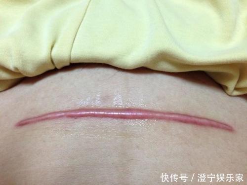 二胎|剖腹产的5个隐形后遗症,在生二胎时才会现形,准妈妈要谨慎考虑