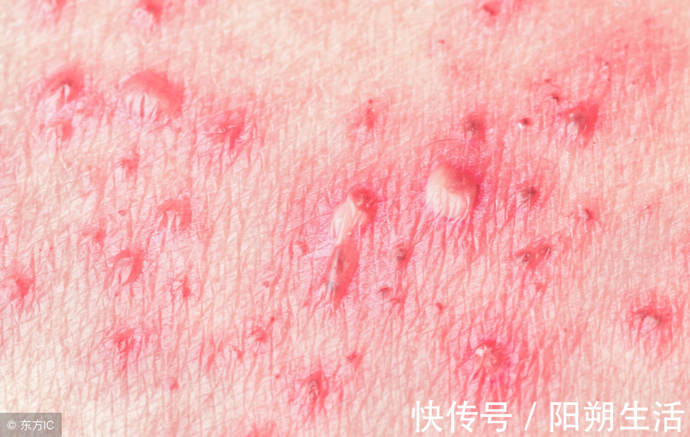 验方|秋冬“缠腰蛇”多发,会传染,试试民间小验方,少遭罪、好得快!