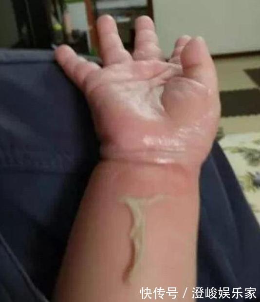 妈咪|4岁男童被烫伤,爸爸的处理方式被医生痛批,医生太无知了