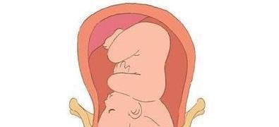 早产|孕28周, 胎宝宝入盆了, 无奈中!