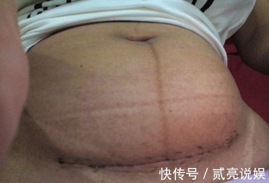 晓丽|女子剖腹产三个月伤口冒水，医生检查伤口，不淡定