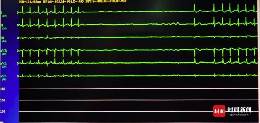 起搏器|刷新记录！四川泸州99岁超高龄患者成功植入心脏起搏器重获“心生”