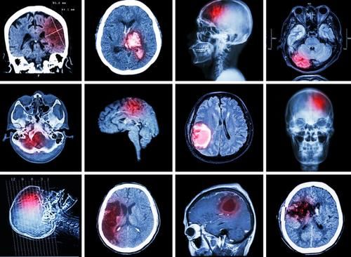 磁场|为什么连医生都建议尽量不要做“磁共振”?或与这“3点”有关系