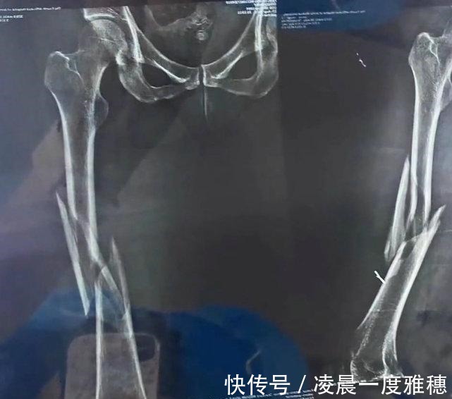 瑜伽|女子练瑜伽被教练压断大腿！网友下手太狠了！