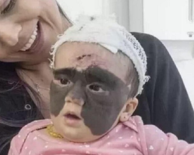 整容|“蝙蝠侠宝宝”火了,美国夫妇将她送去整容祛除胎记,后来怎么样