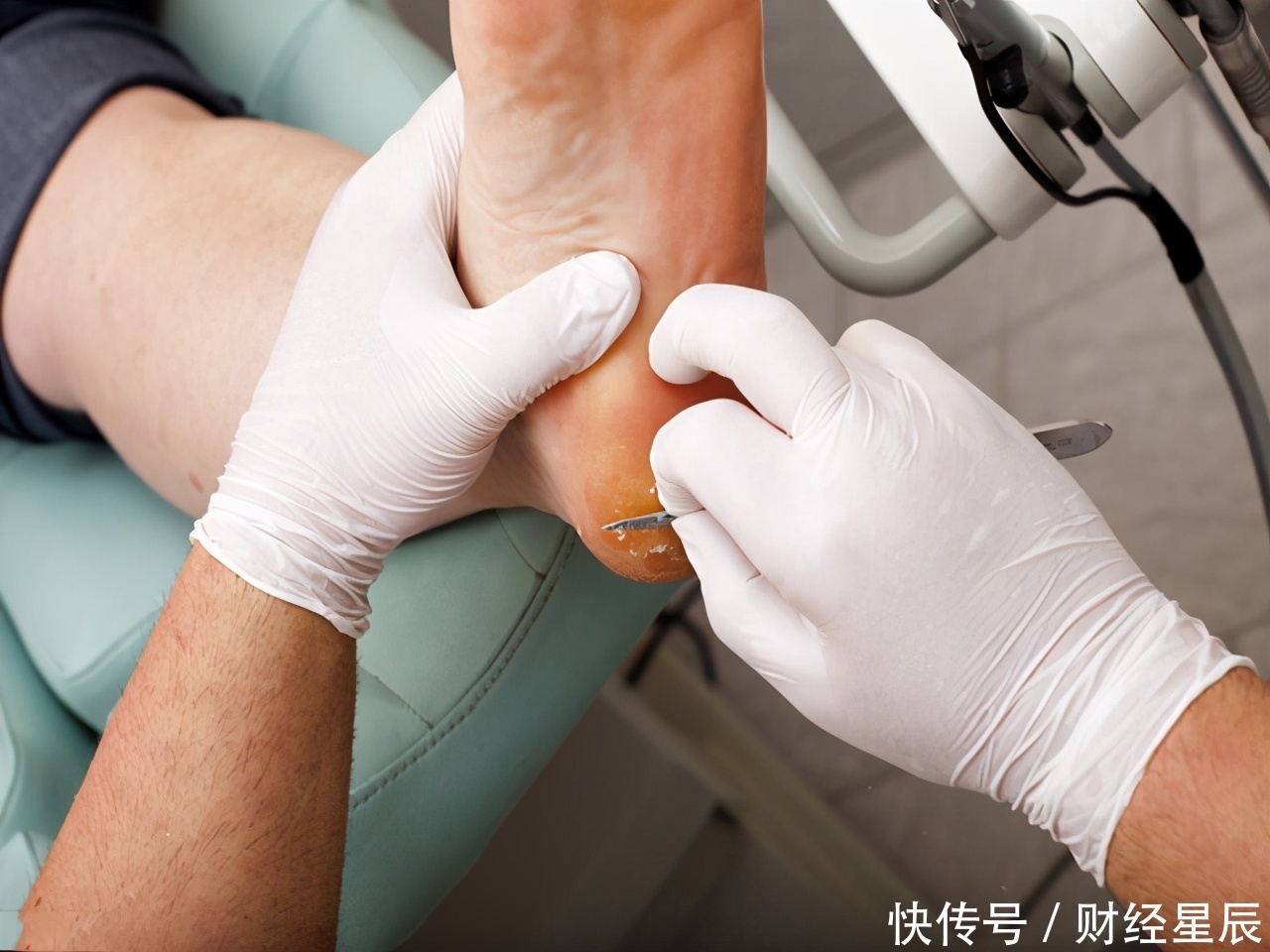 病变|肝有问题,脚先知?脚上出现3个“毛病”,肝脏或病变,要重视