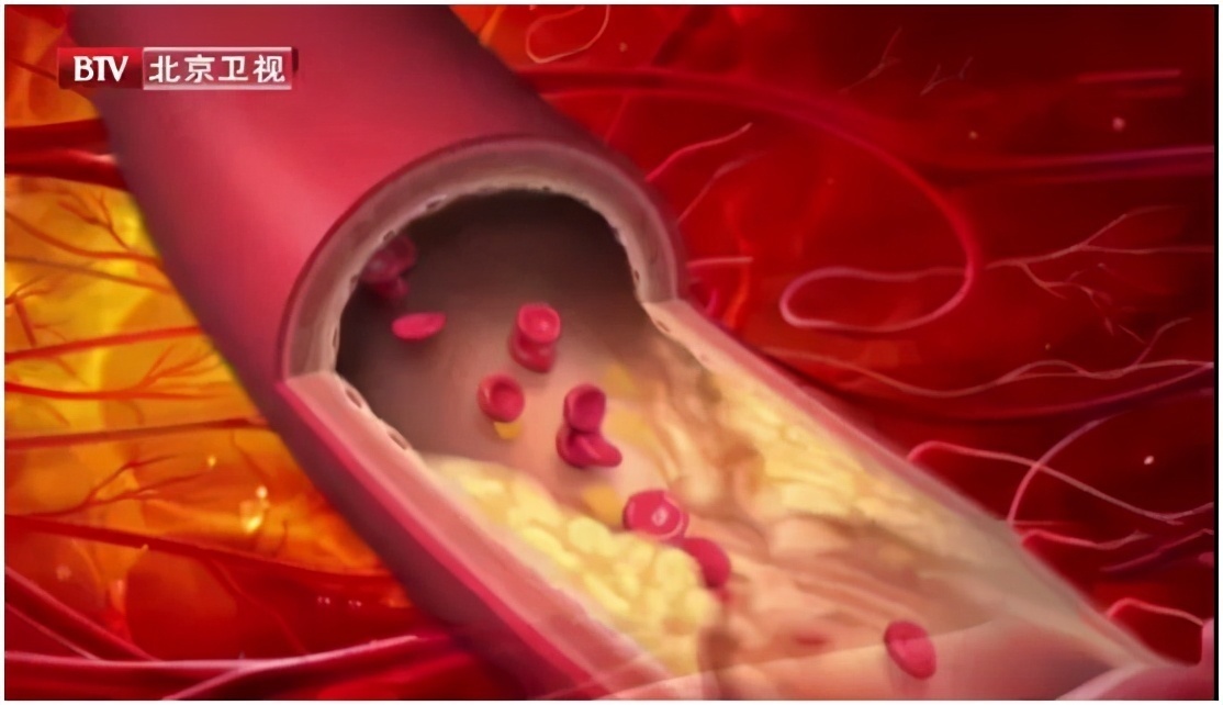 副作用|他汀的副作用不只是伤肝!还能不能吃用好它血管通畅更健康