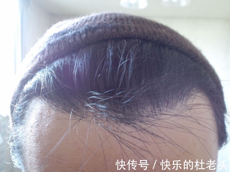 移植 植发后会掉发吗?谁要说百分百不掉发,不是心黑就是无知!