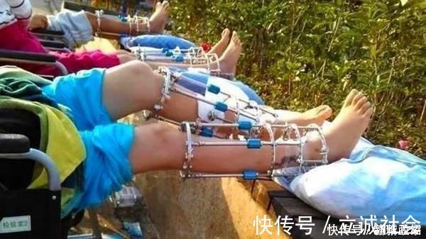 禾苗|男孩为当飞行员花16万断骨增高,多年后,因“长高”毁掉人生