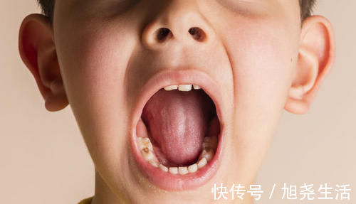 牙齿|牙科医生提醒:5类零食是孩子蛀牙的根源,孩子再馋也别吃