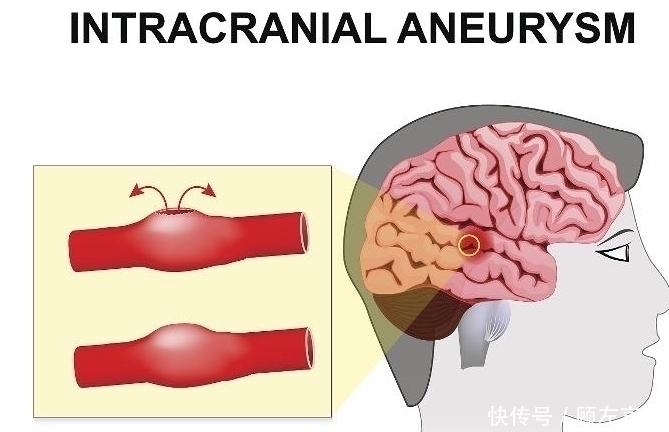 胆固醇|吃鸡蛋对身体好,但高血压患者能吃吗?答案可能和你想的不一样!