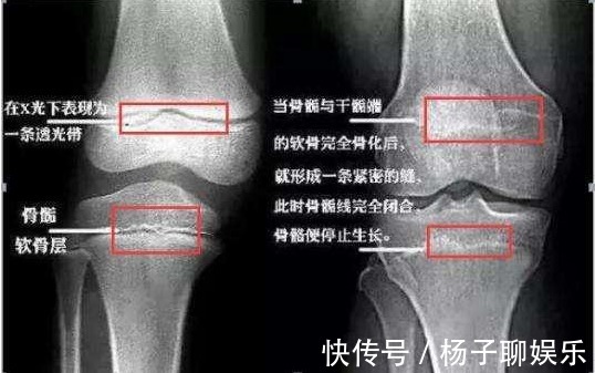 骨龄|家长如何分辨,孩子是属于个子矮,还是晚长个呢医生说看这3点