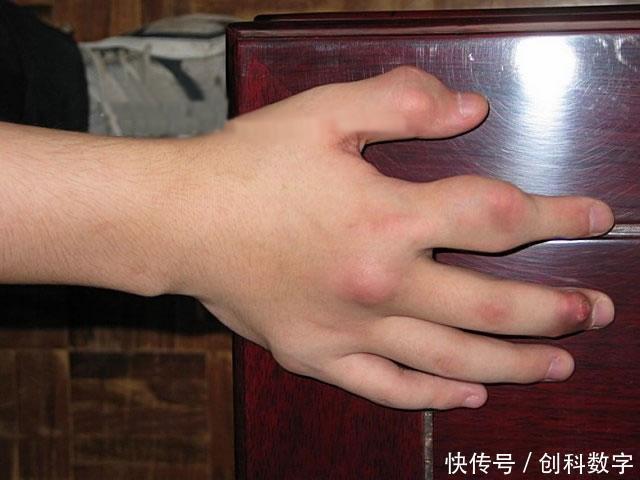 养肝|他喝酒50年,自称不怕痛风,秘诀只有1个,尿酸保持得好