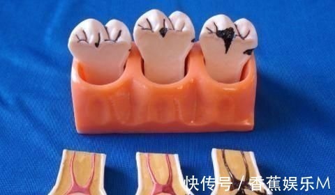 宝爸|2岁孩子满嘴“小黑牙”,医生不是因为糖,是父母的无知