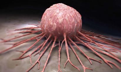 手术切除|癌症手术切除以后，是否需要辅助化疗，主要取决于以下两种情况