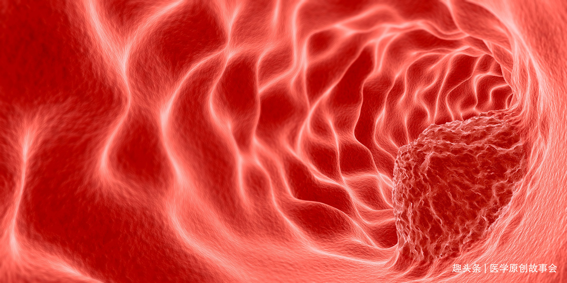 大肠癌|体内有癌,大便先知大便出现这六种表现,真的提示癌症到访吗