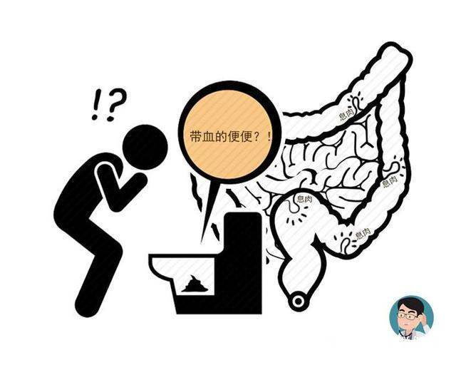 大便|早期的腸癌，癥狀很細微若排便出現這4個現象，那就要當心了