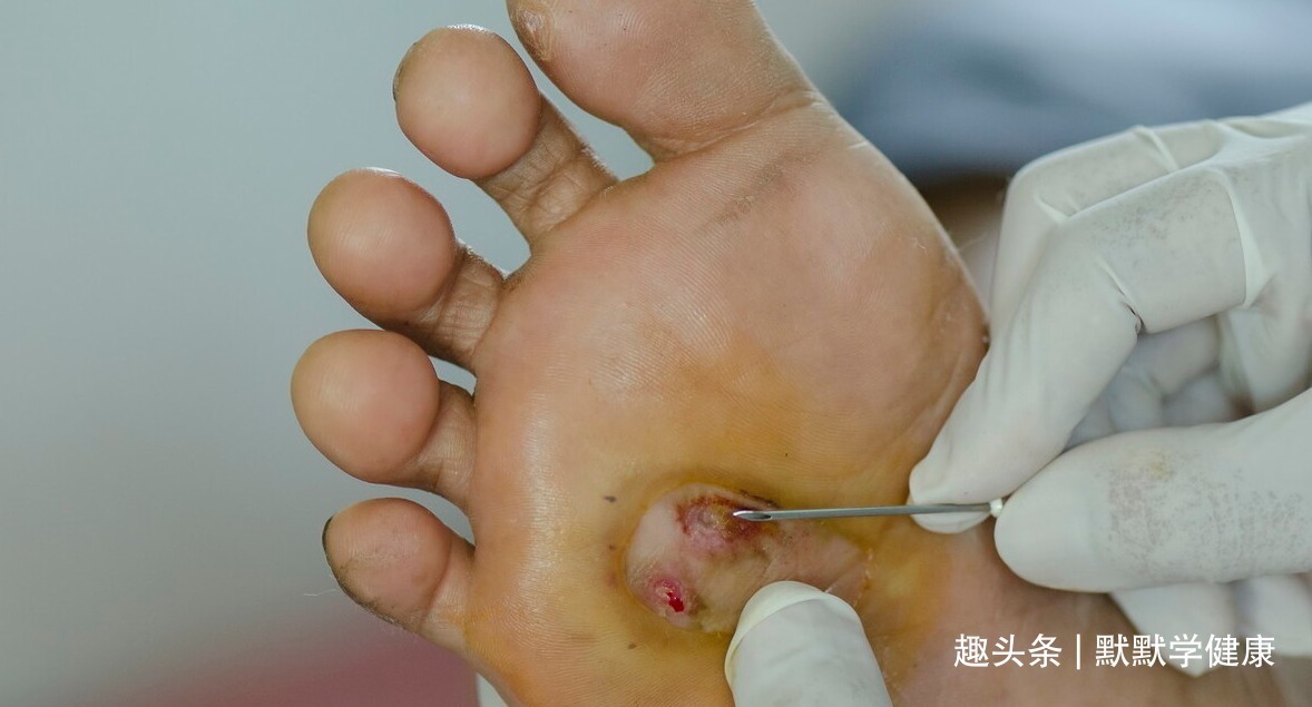 症状|糖尿病足是每个糖友的“噩梦”!医生提醒出现4个症状就该警惕