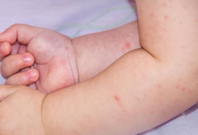 接种疫苗|宝宝接种疫苗后，如果出现这8种不良反应，要赶紧送医院！