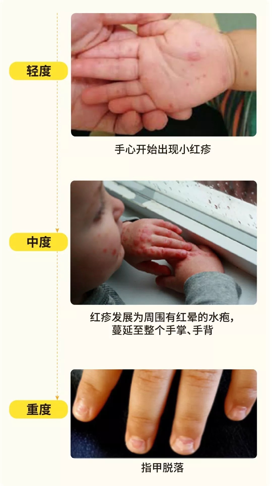 杨俊|柳州已有班级停课!这种传染病进入高发期,如何预防、护理看这→