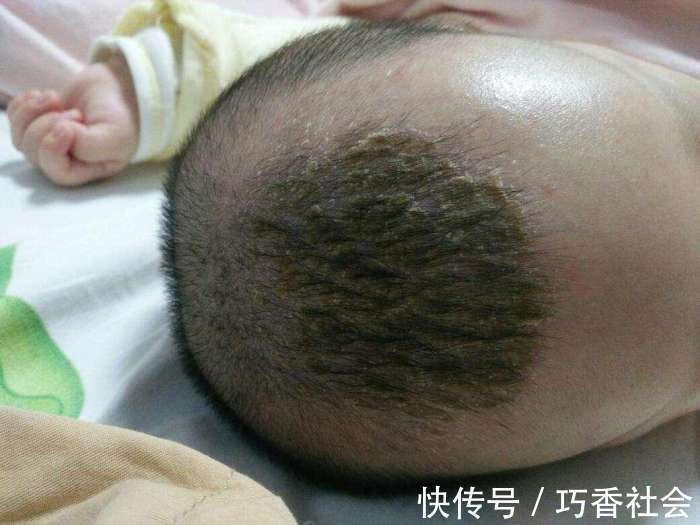 怒斥|刚满月的宝宝就高烧不退!医生看到宝宝的头皮后怒斥她不配做妈妈