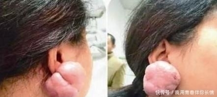 打耳洞|女孩打耳洞后长出鸡蛋大“肉球”,医生提醒打耳洞要注意两点