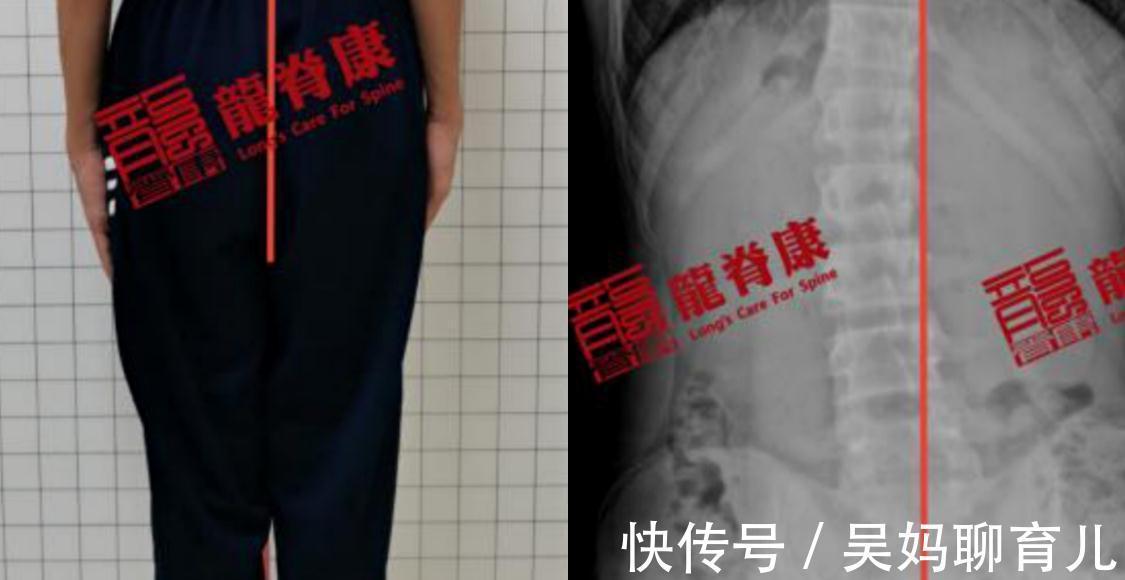小陈|孩子出现高低肩、身体偏歪?小心这可能是脊柱侧弯惹的祸