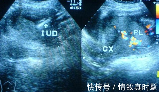 怀孕|孕妈生完孩子后要不要上环 看完这4点, 你再做决定吧!