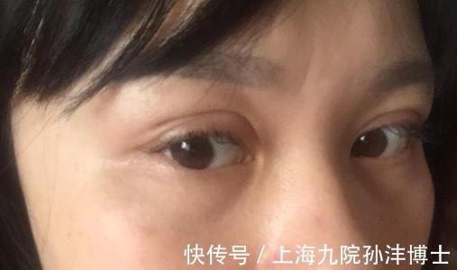 双眼皮 眼修复孙沣博士:双眼皮术后出现分叉能修复吗?