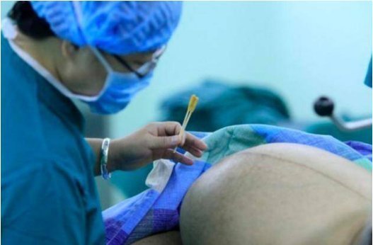 伟大|剖腹产不就是“划肚取胎”组图揭秘全过程,看完才懂母亲的伟大