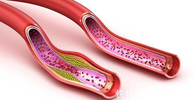 通血管|吃木耳能通血管北大教授大错特错,真正能通血管的是这1件事