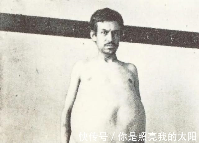 约翰|他是唯一被憋死的人：便秘3年没排泄，去世后尸检肠内大便重36斤