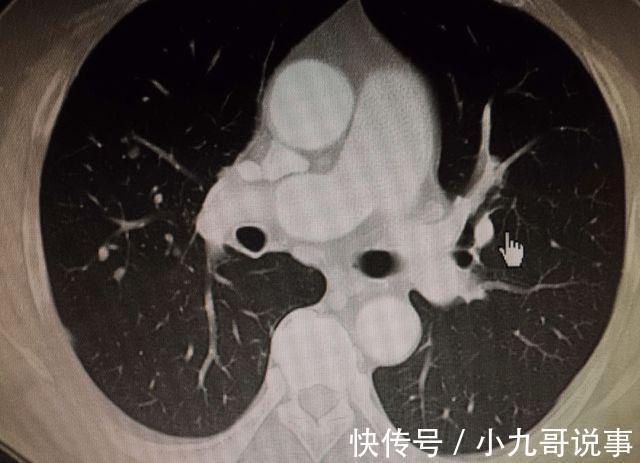 服装店|44岁大姐查出7mm肺结节,半年结节逐渐消失,医生:方法值得借鉴