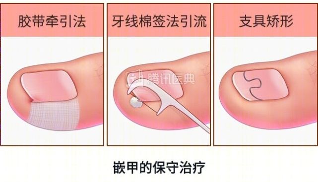 脚趾|趾甲长进肉里那种钻心的痛，竟和3个习惯有关