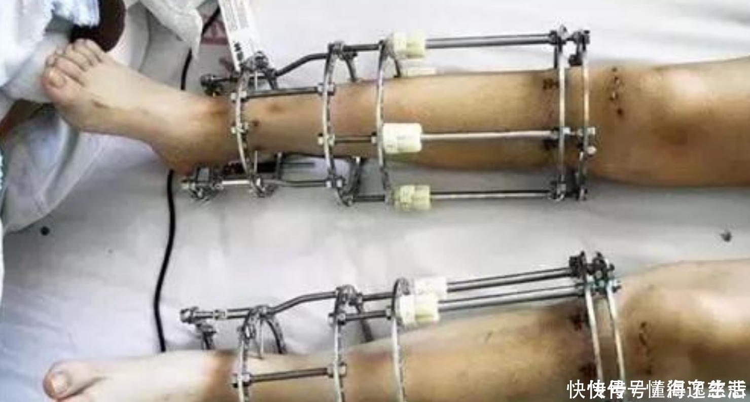 断骨|6年前花16万，断骨增高7.2厘米的男生李亚诺，现在代价来了