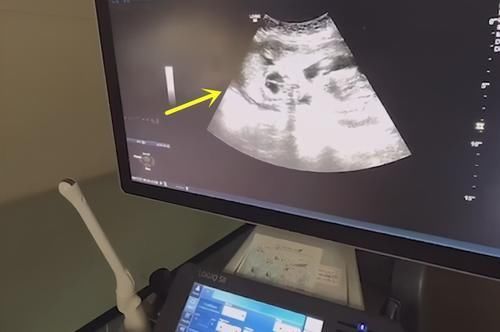 检查|儿子哭着求妈妈留下二胎,每次产检必到场,看过检查结果才安心
