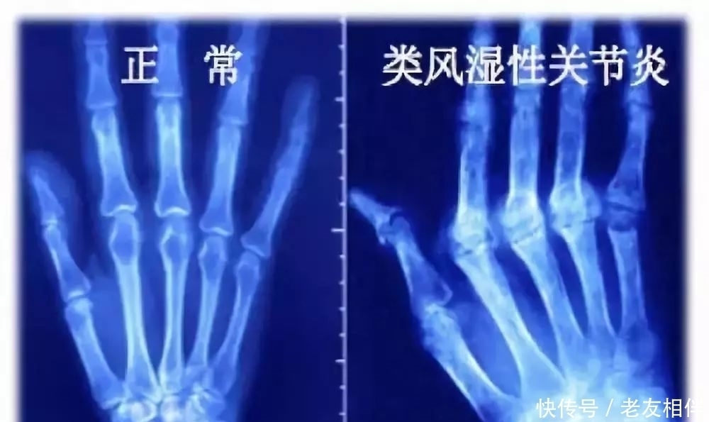 要命|髋关节疼起来真要命,到底为什么这么痛?要怎么治疗?