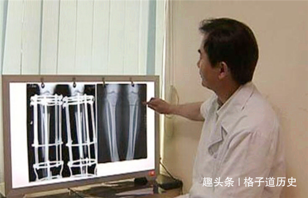 李亚诺|当年那个花费16万,断骨增高7.2厘米的男生李亚诺,如今怎样了