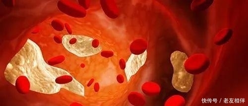 甘油三酯高,可以吃脂肪高的花生、瓜子等坚果吗?营养师告诉你