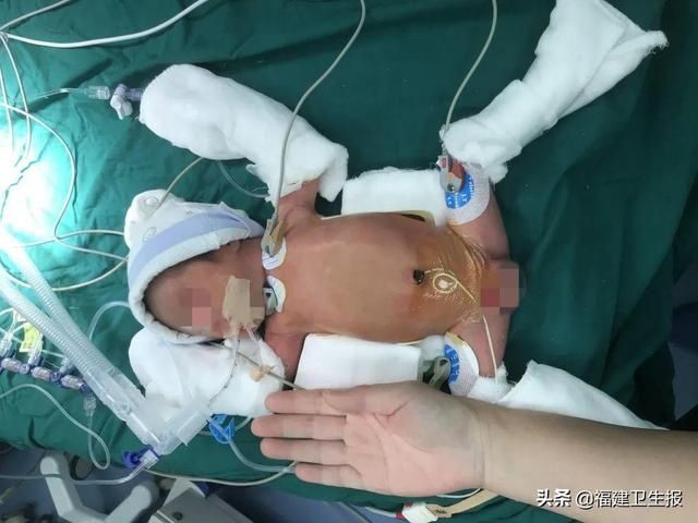 十二指肠|在肠子上做“微雕”，省立医院多学科团队合力救治“巴掌男婴”
