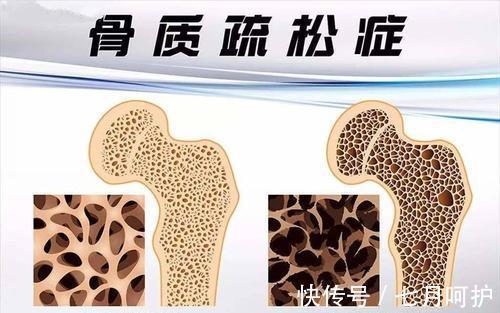 医生|生命在于运动,医生提醒:过了45岁,这3种运动尽量少做