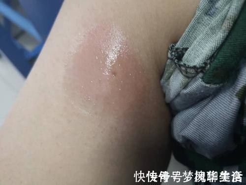 真相|蜂毒能以毒攻毒,消灭癌细胞?最新研究结果,告诉你事实真相