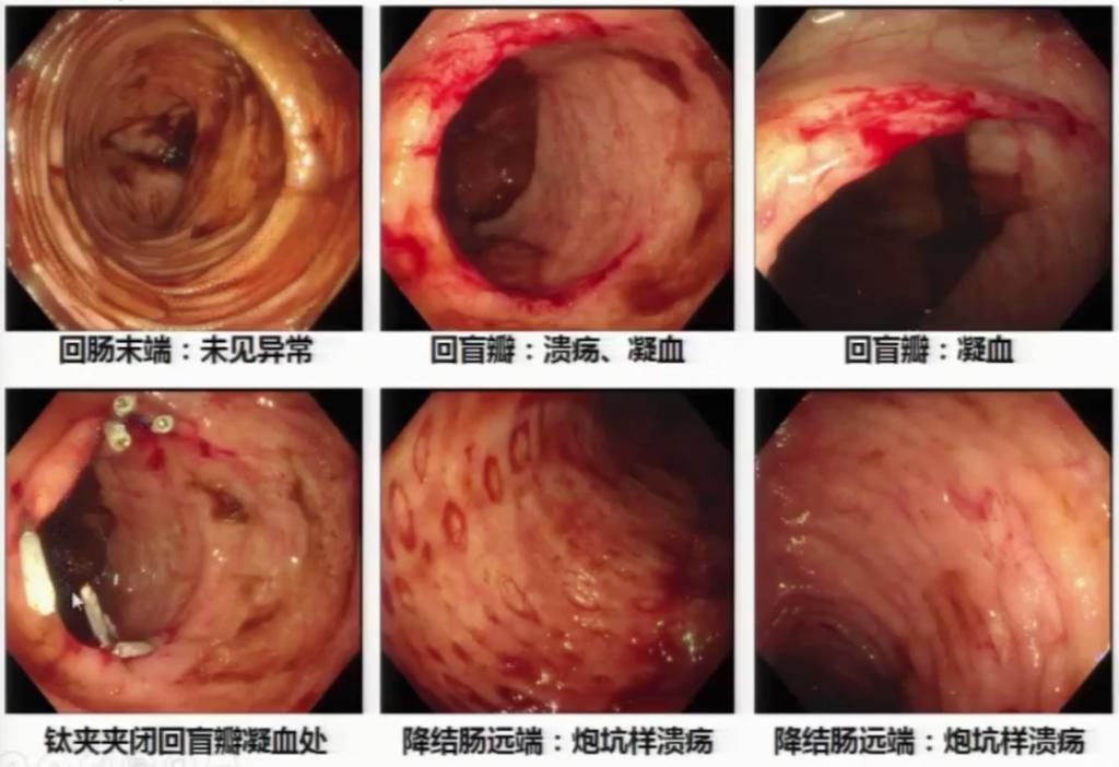 休克|反复便血十余天，一度出现失血性休克，原因竟然是……
